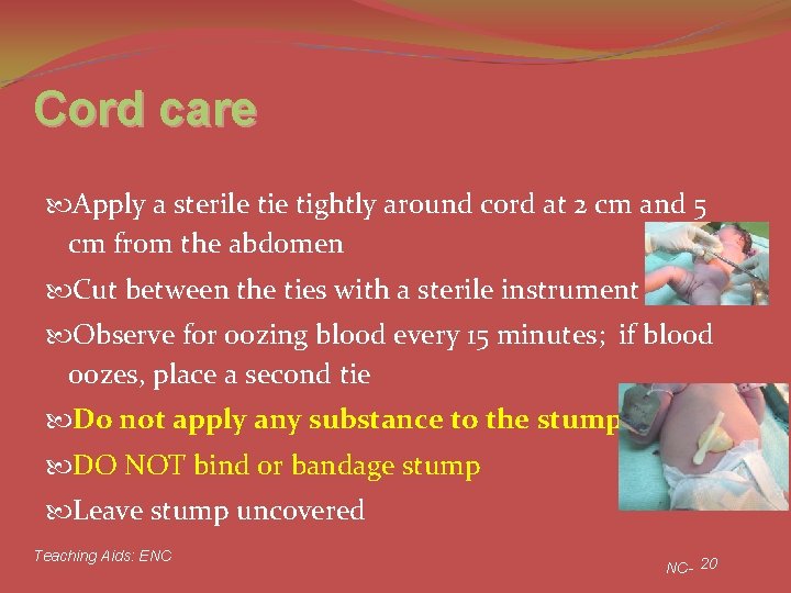 Cord care Apply a sterile tightly around cord at 2 cm and 5 cm