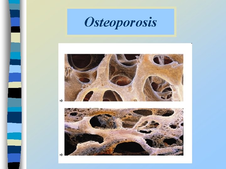 Osteoporosis 
