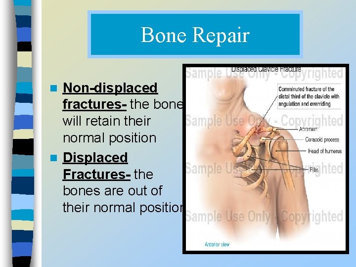 Bone Repair Non-displaced fractures- the bone will retain their normal position n Displaced Fractures-