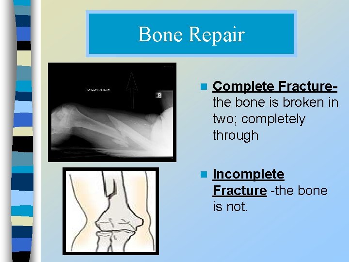 Bone Repair n Complete Fracturethe bone is broken in two; completely through n Incomplete