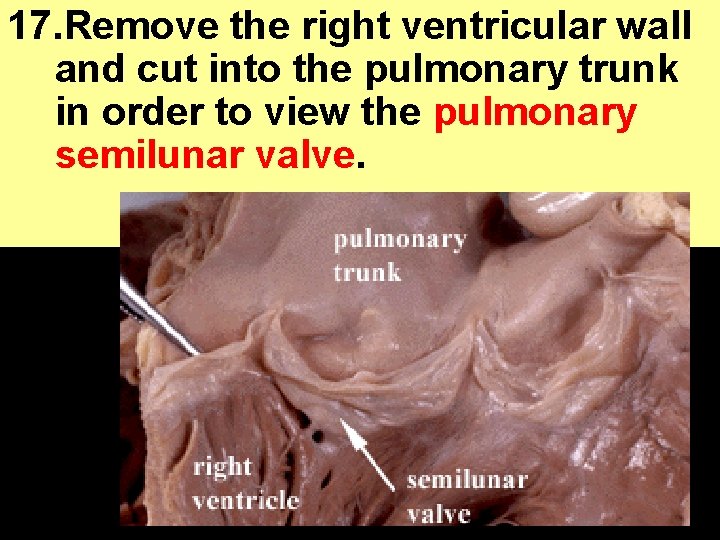 17. Remove the right ventricular wall and cut into the pulmonary trunk in order