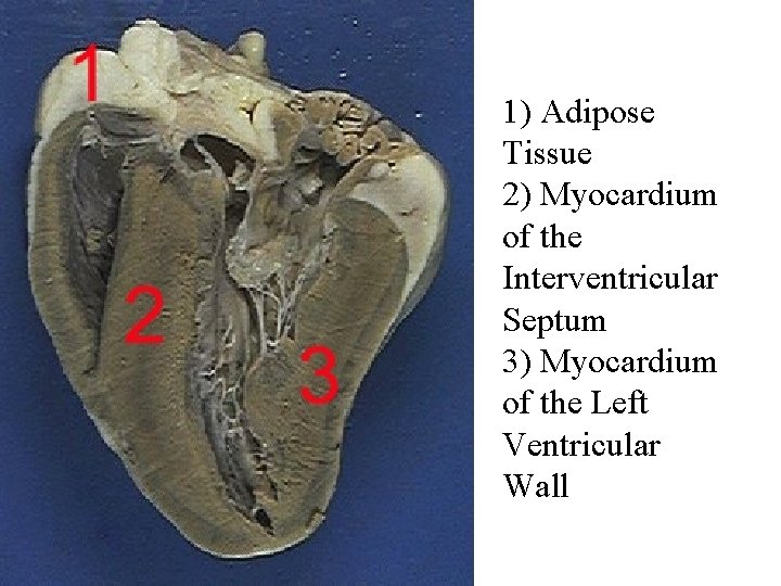 1) Adipose Tissue 2) Myocardium of the Interventricular Septum 3) Myocardium of the Left