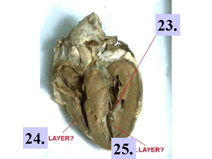 HEART DISSECTION LAB Procedure 1 Obtain a dissection