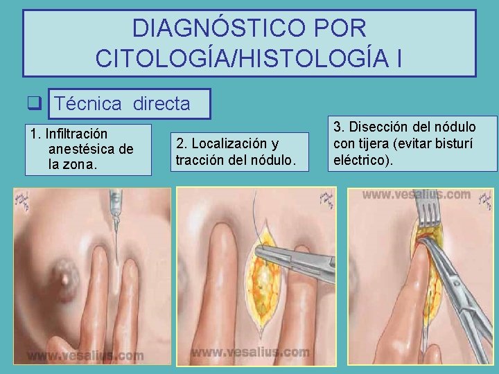 DIAGNÓSTICO POR q Técnica: CITOLOGÍA/HISTOLOGÍA I q Técnica directa 1. Infiltración anestésica de la