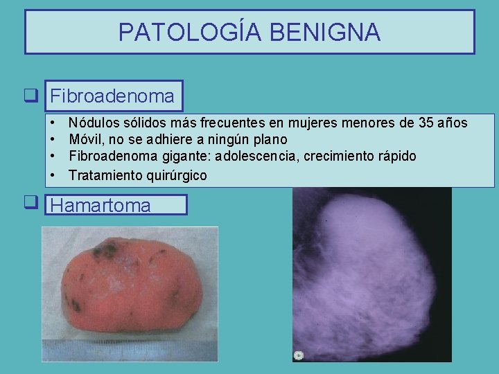 PATOLOGÍA BENIGNA q Fibroadenoma • • Nódulos sólidos más frecuentes en mujeres menores de