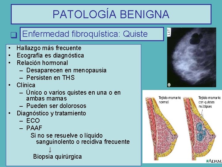 PATOLOGÍA BENIGNA q Enfermedad fibroquística: Quiste • Hallazgo más frecuente • Ecografía es diagnóstica