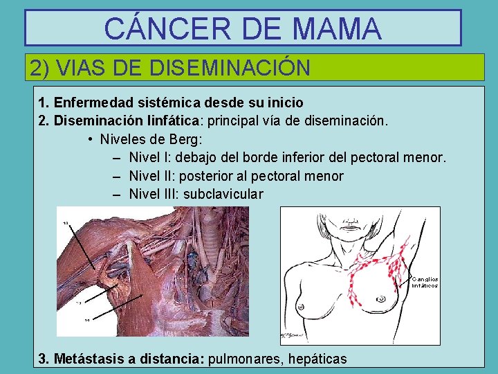 CÁNCER DE MAMA 2) VIAS DE DISEMINACIÓN 1. Enfermedad sistémica desde su inicio 2.