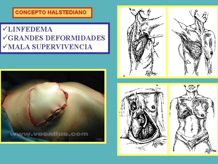CONCEPTO HALSTEDIANO üLINFEDEMA üGRANDES DEFORMIDADES üMALA SUPERVIVENCIA 