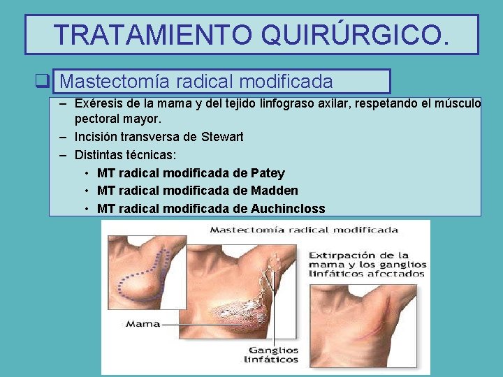 TRATAMIENTO QUIRÚRGICO. q Mastectomía radical modificada – Exéresis de la mama y del tejido