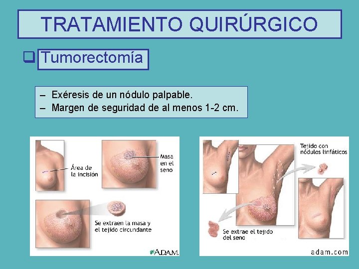 TRATAMIENTO QUIRÚRGICO q Tumorectomía – Exéresis de un nódulo palpable. – Margen de seguridad