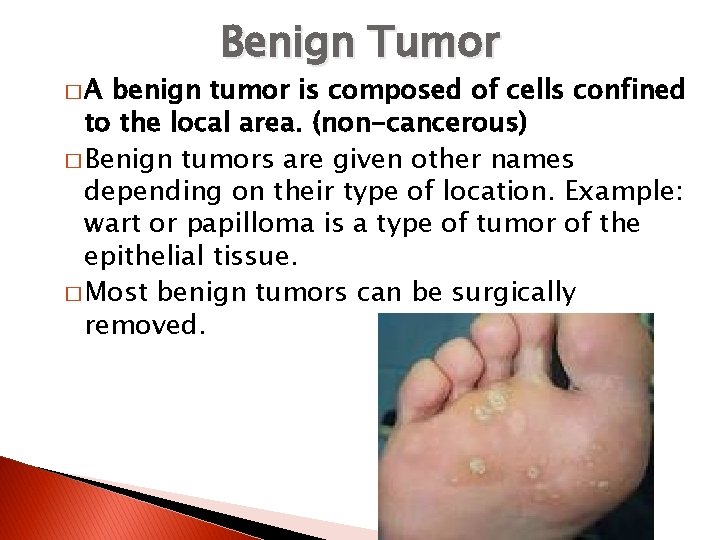 �A Benign Tumor benign tumor is composed of cells confined to the local area. �A Benign Tumor benign tumor is composed of cells confined to the local area.