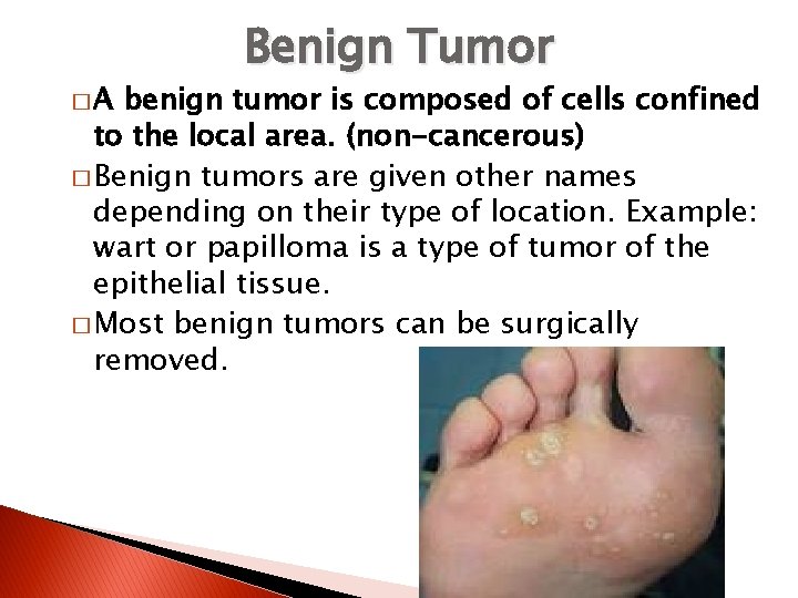 �A Benign Tumor benign tumor is composed of cells confined to the local area.