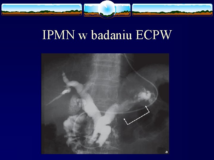 IPMN w badaniu ECPW 