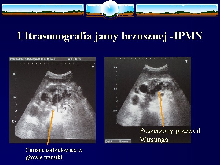 Ultrasonografia jamy brzusznej -IPMN Poszerzony przewód Wirsunga Zmiana torbielowata w głowie trzustki 