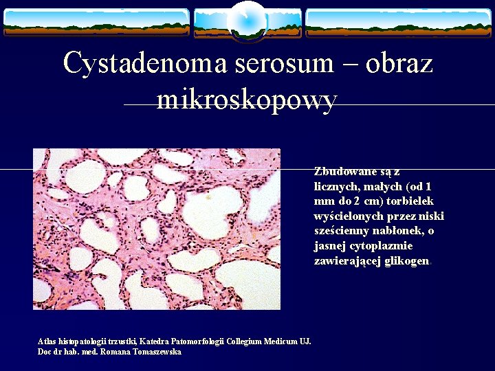 Cystadenoma serosum – obraz mikroskopowy Zbudowane są z licznych, małych (od 1 mm do