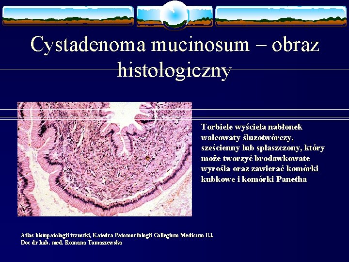 Cystadenoma mucinosum – obraz histologiczny Torbiele wyściela nabłonek walcowaty śluzotwórczy, sześcienny lub spłaszczony, który