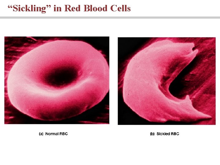 “Sickling” in Red Blood Cells 
