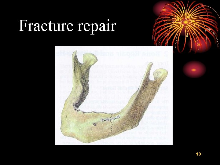 Fracture repair 13 