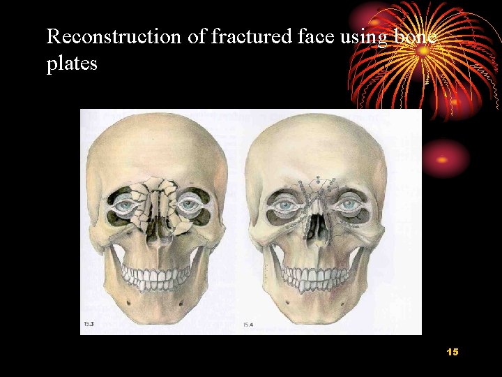 Reconstruction of fractured face using bone plates 15 