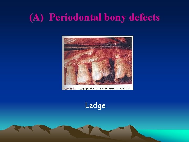 (A) Periodontal bony defects Ledge 