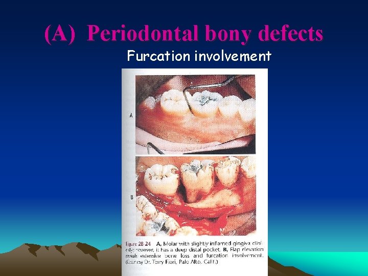 (A) Periodontal bony defects Furcation involvement 