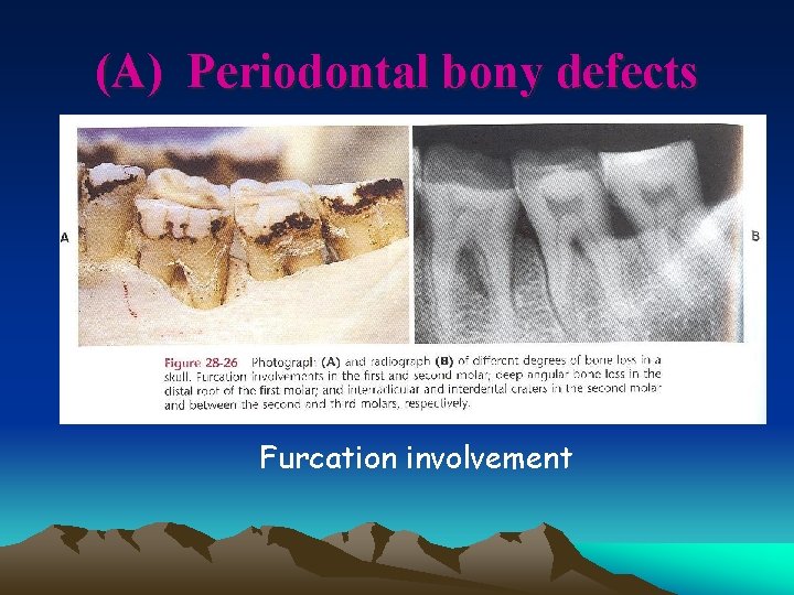 (A) Periodontal bony defects Furcation involvement 