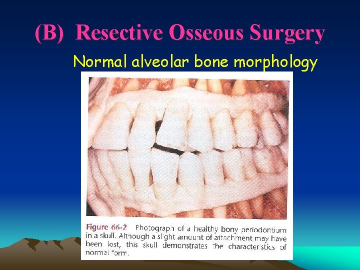 (B) Resective Osseous Surgery Normal alveolar bone morphology 