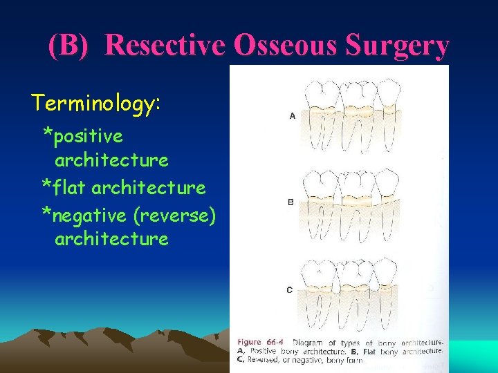 (B) Resective Osseous Surgery Terminology: *positive architecture *flat architecture *negative (reverse) architecture 