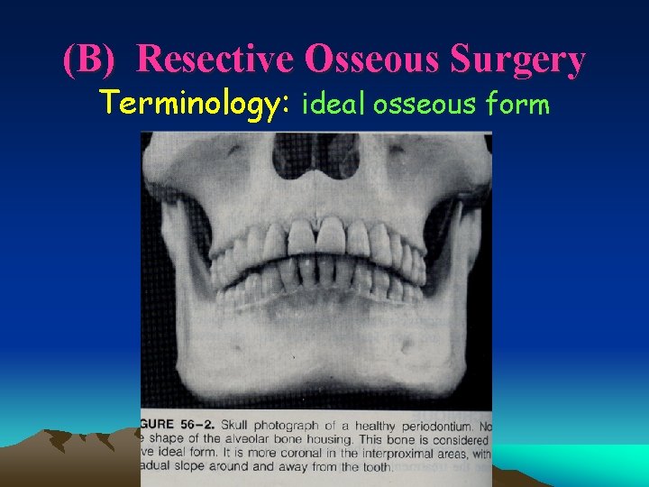 (B) Resective Osseous Surgery Terminology: ideal osseous form 