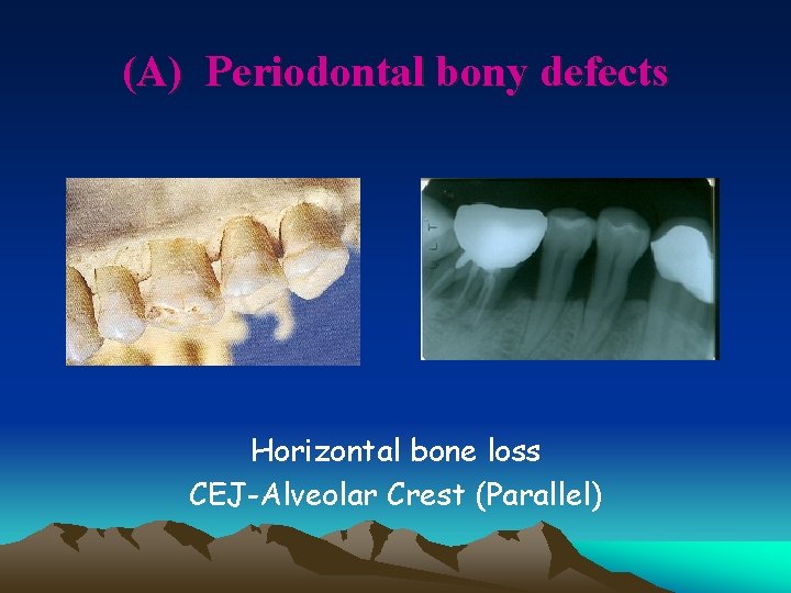 (A) Periodontal bony defects Horizontal bone loss CEJ-Alveolar Crest (Parallel) 