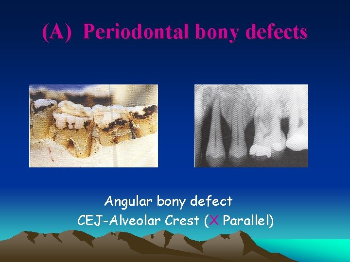 (A) Periodontal bony defects Angular bony defect CEJ-Alveolar Crest (X Parallel) 