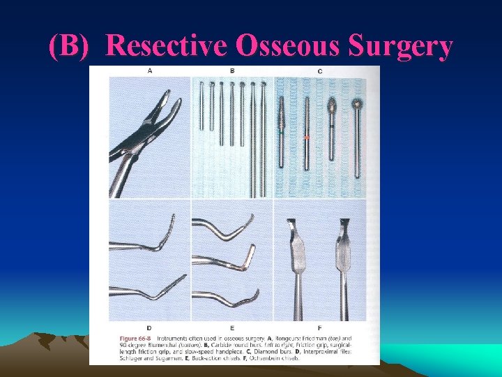 (B) Resective Osseous Surgery 