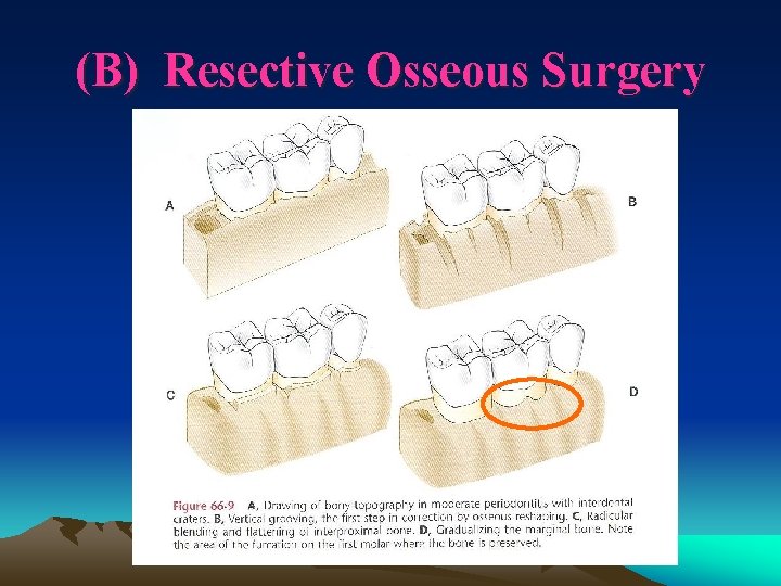 (B) Resective Osseous Surgery 