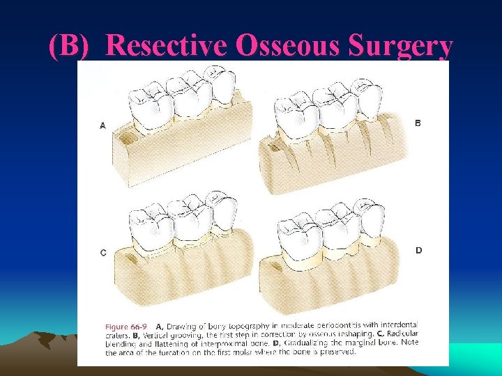 (B) Resective Osseous Surgery 