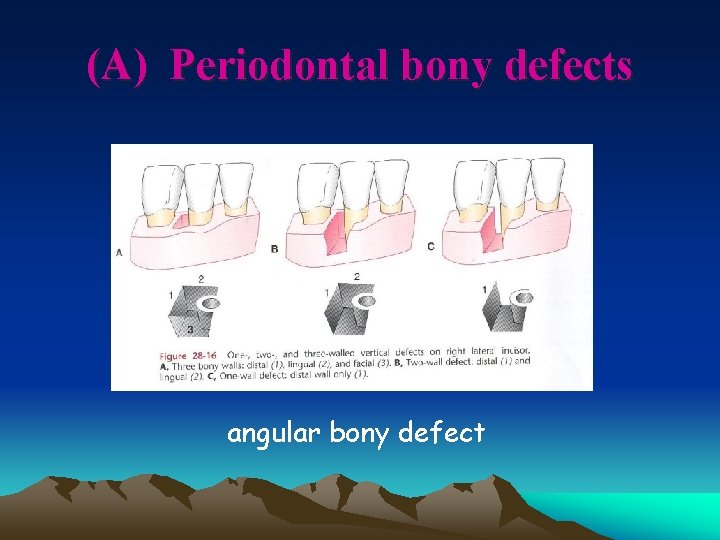 (A) Periodontal bony defects angular bony defect 