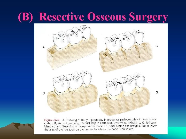 (B) Resective Osseous Surgery 