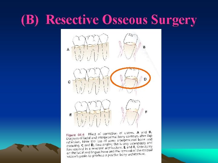 (B) Resective Osseous Surgery 