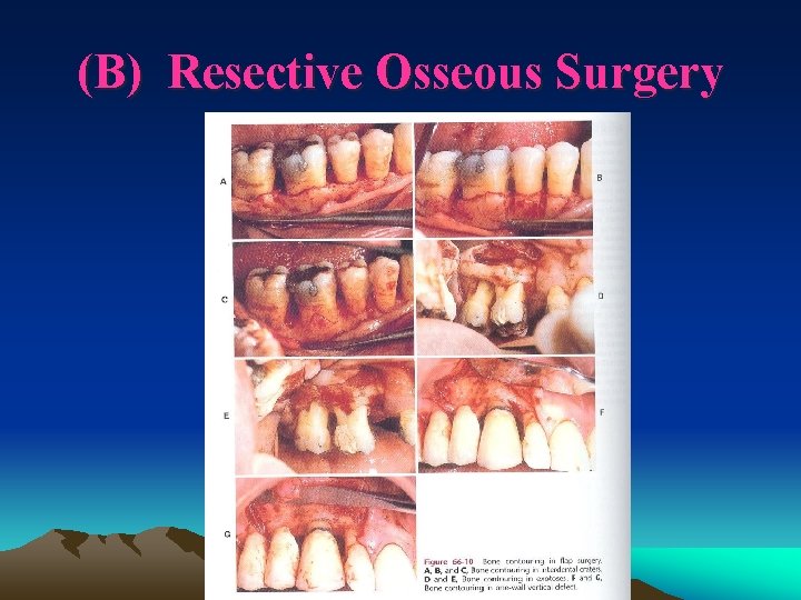 (B) Resective Osseous Surgery 