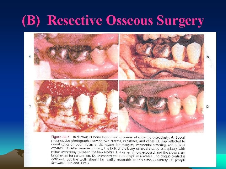 (B) Resective Osseous Surgery 