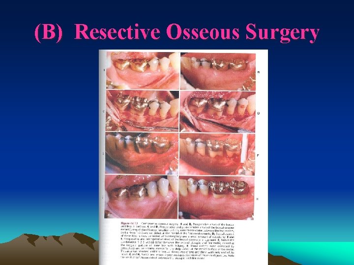 (B) Resective Osseous Surgery 