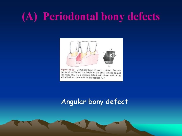(A) Periodontal bony defects Angular bony defect 