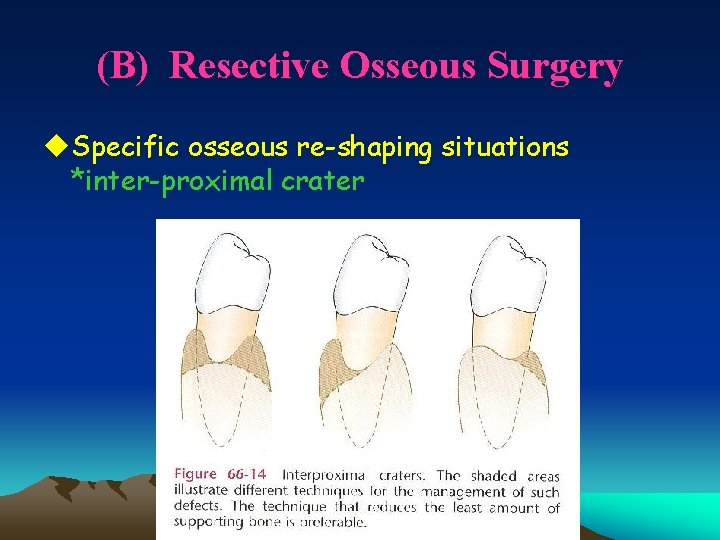 (B) Resective Osseous Surgery u. Specific osseous re-shaping situations *inter-proximal crater 