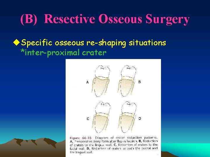 (B) Resective Osseous Surgery u. Specific osseous re-shaping situations *inter-proximal crater 