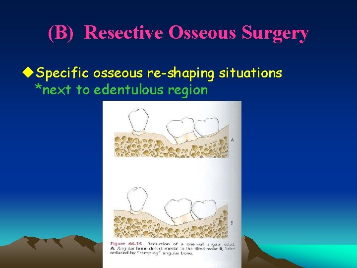 (B) Resective Osseous Surgery u. Specific osseous re-shaping situations *next to edentulous region 