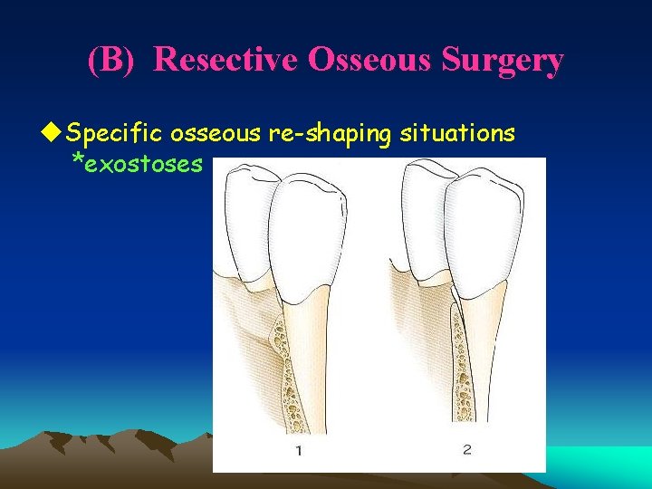 (B) Resective Osseous Surgery u. Specific osseous re-shaping situations *exostoses 