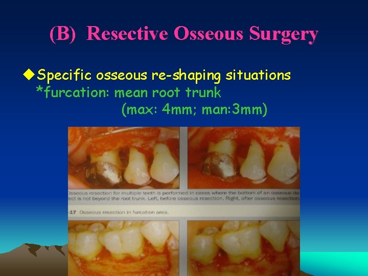 (B) Resective Osseous Surgery u. Specific osseous re-shaping situations *furcation: mean root trunk (max: