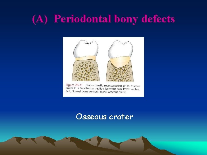 (A) Periodontal bony defects Osseous crater 