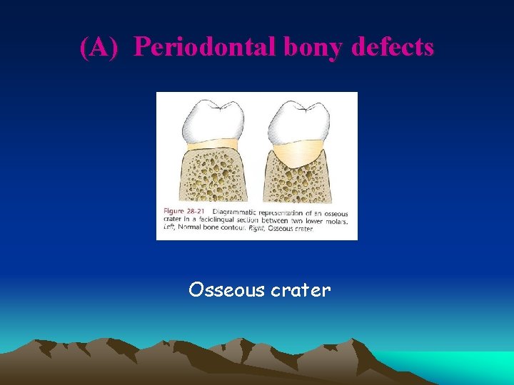 (A) Periodontal bony defects Osseous crater 