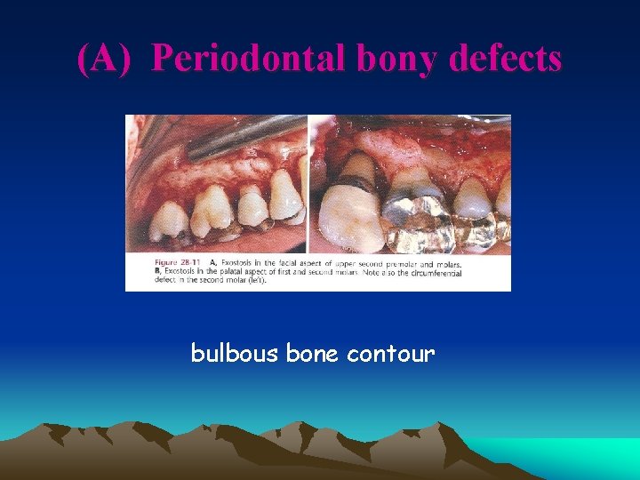 (A) Periodontal bony defects bulbous bone contour 