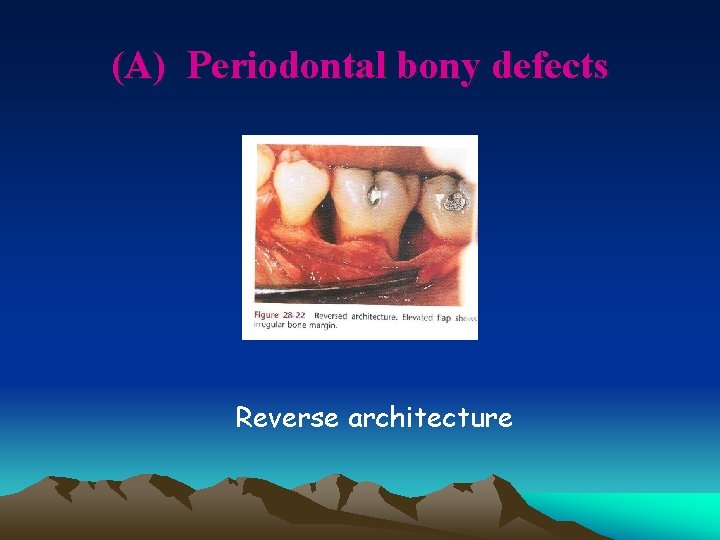 (A) Periodontal bony defects Reverse architecture 